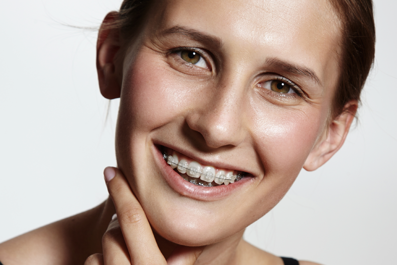 Niềng răng mắc cài sứ