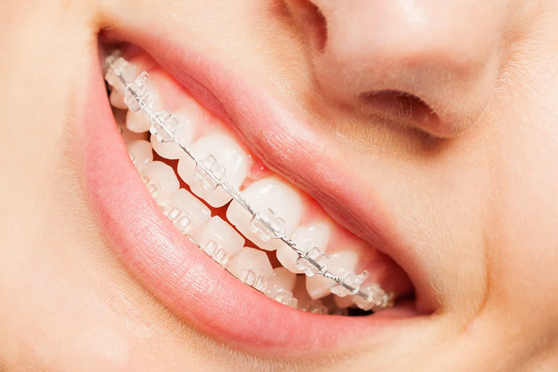 nha khoa anh thu nieng răng mắc cài sứ 2