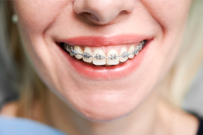 Niềng Răng Mắc Cài Tự Buộc