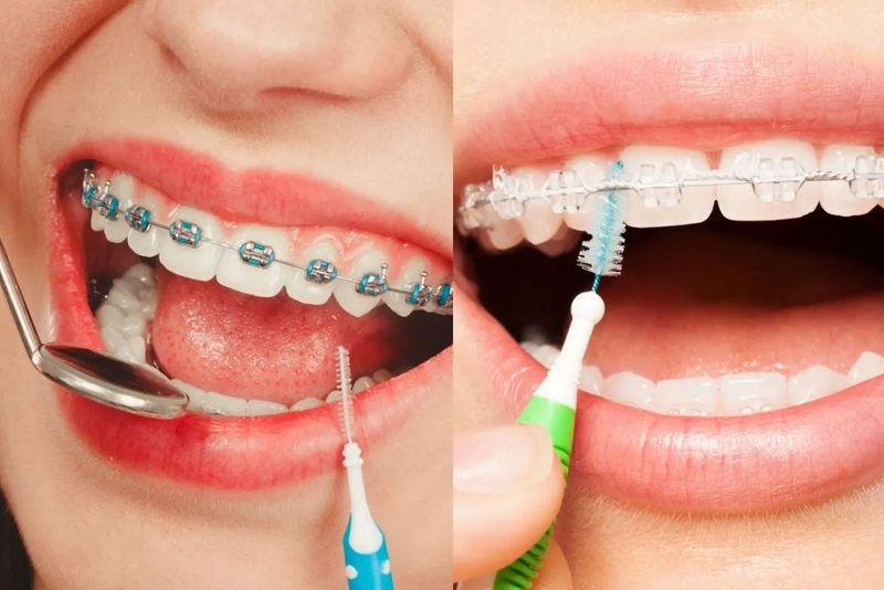 nha khoa anh thư niềng răng trẻ em 5