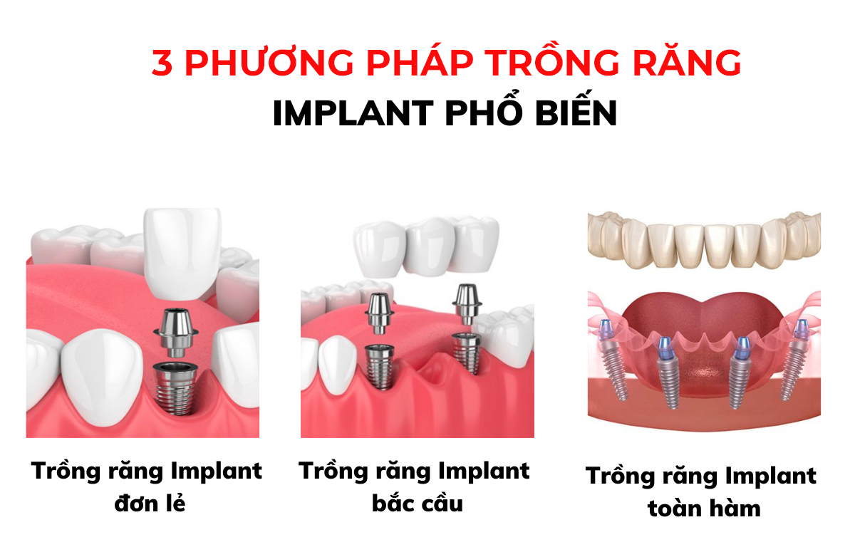 3 phương pháp trồng răng Implant