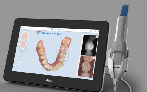 CÔNG NGHỆ QUÉT MẪU RĂNG 3D-CHUẨN XÁC, NHANH CHÓNG & KHÔNG GÂY KHÓ CHỊU