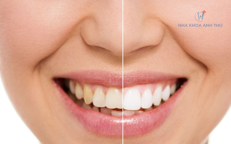 nha-khoa-anh-thu-rang-cua-tham-my-3