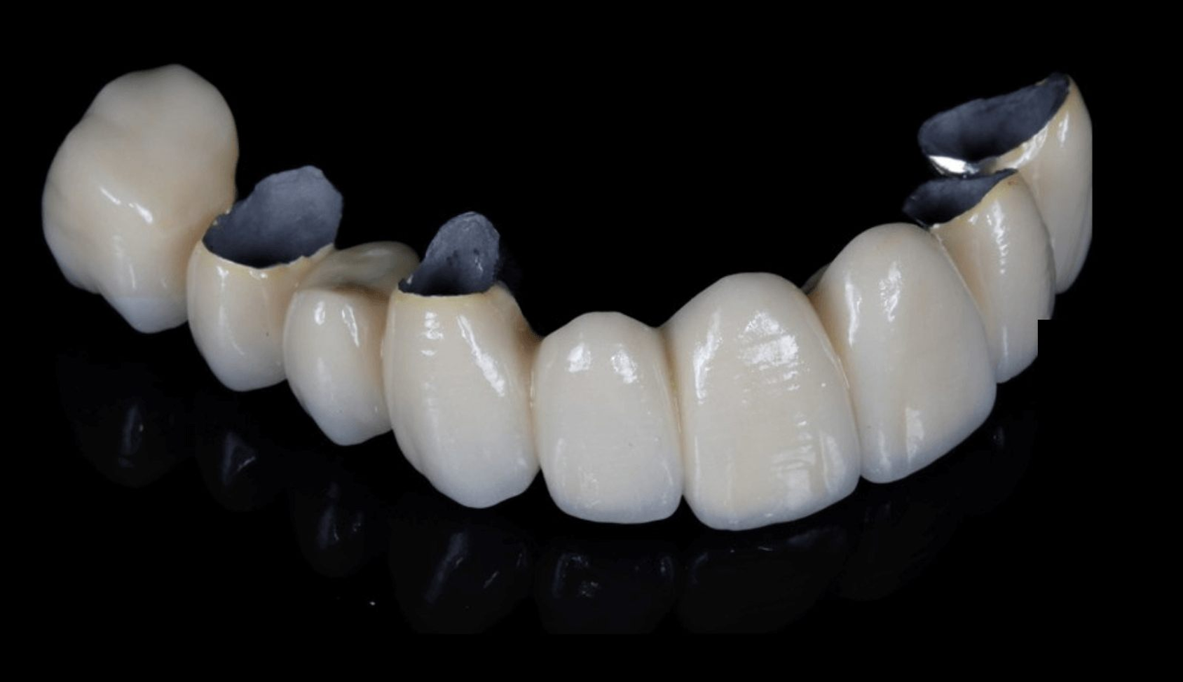 răng sứ kim loại thường