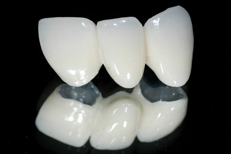 nha-khoa-anh-thu-rang-su-kim-loai-titan-1