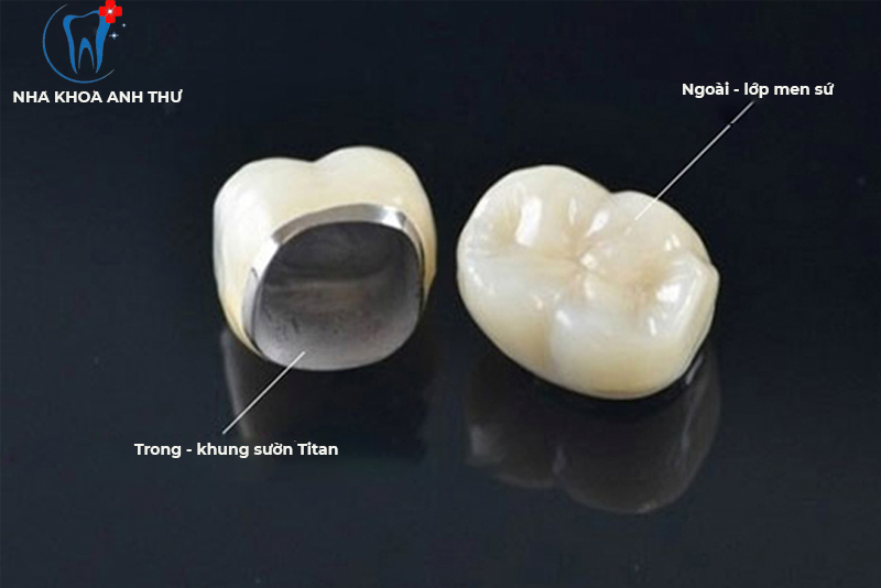 nha-khoa-anh-thu-rang-su-kim-loai-titan-2