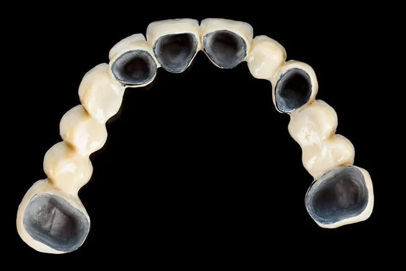 nha-khoa-anh-thu-rang-su-kim-loai-titan-3