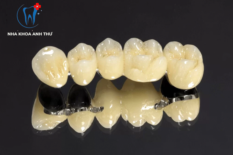 nha-khoa-anh-thu-rang-su-kim-loai-titan-4