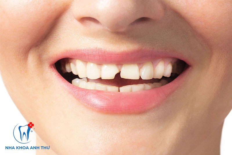 nha-khoa-anh-thu-rang-su-kim-loai-titan-5