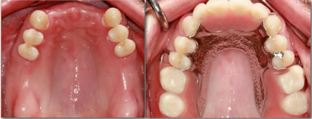 nha khoa anh thu răng tháo lắp 9