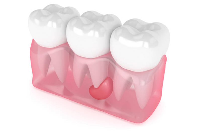 nha khoa anh thư sưng nươu răng 5