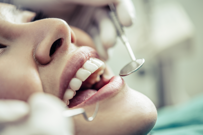 TẨY TRẮNG RĂNG DỄ DÀNG TẠI NHA KHOA ANH THƯ