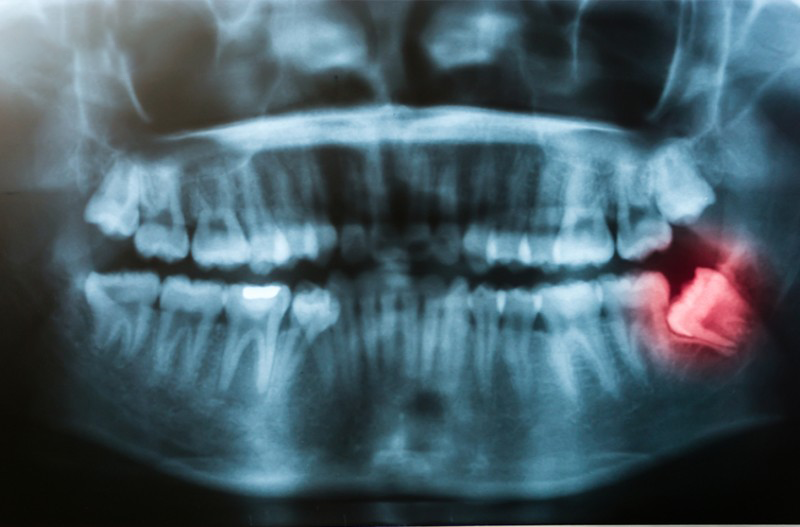 răng số 8 mọc lệch 
