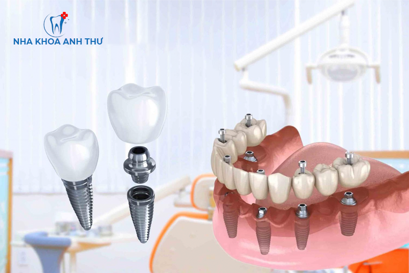nha-khoa-anh-thu-trong-rang-Implant-Mỹ-1