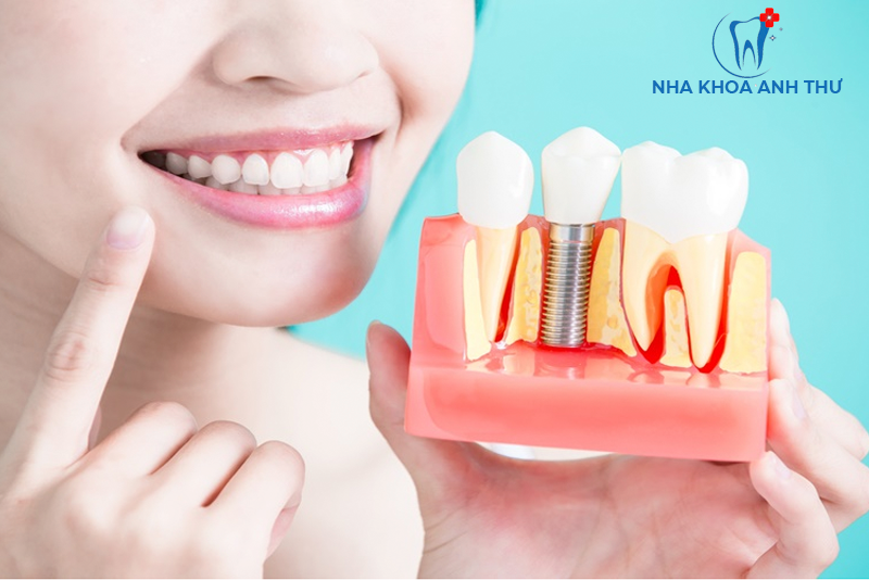 nha-khoa-anh-thu-trong-rang-Implant-Mỹ-3