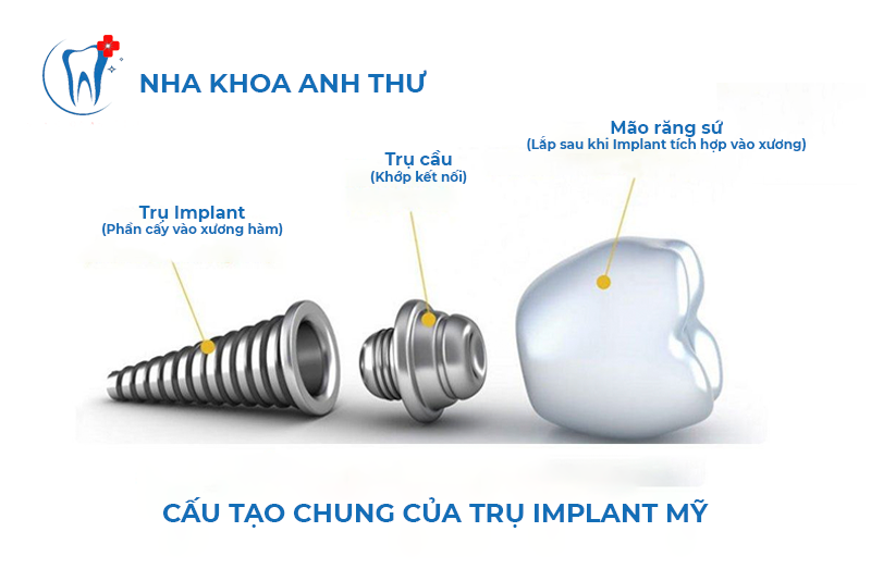 nha-khoa-anh-thu-trong-rang-Implant-Mỹ-4