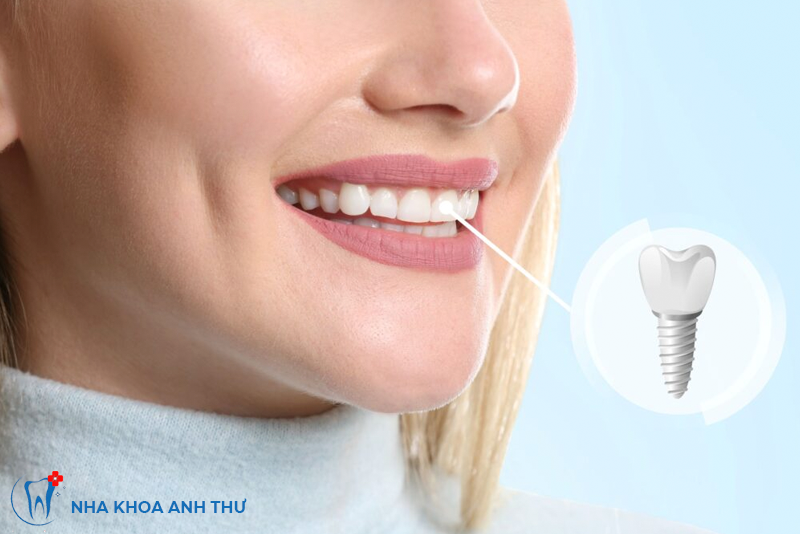 nha-khoa-anh-thu-trong-rang-Implant-Mỹ-6