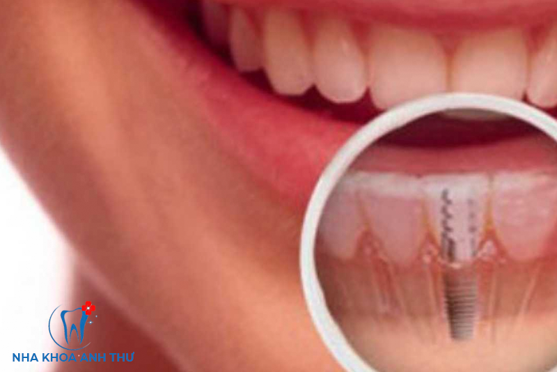 nha-khoa-anh-thu-trong-rang-Implant-Mỹ-7