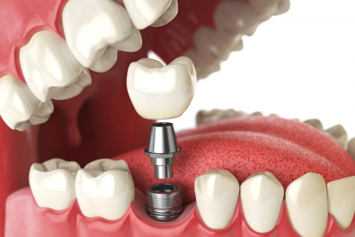 TRỒNG RĂNG IMPLANT NHANH, UY TÍN TẠI NHA KHOA ANH THƯ SƠN TÂY