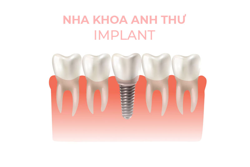 nha-khoa-anh-thu-uu-nhuoc-implant-1