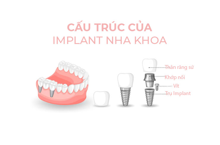 nha-khoa-anh-thu-uu-nhuoc-implant-2