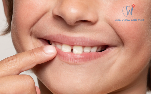 ĐỐM TRẮNG TRÊN RĂNG TRẺ EM: NGUYÊN NHÂN, CÁCH PHÒNG NGỪA VÀ XỬ LÝ 