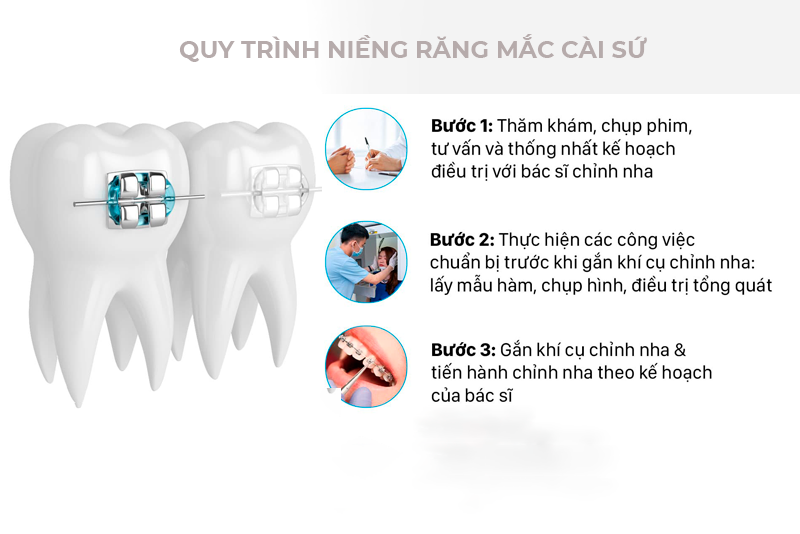 quy trình niềng răng mắc cài sứ tại nha khoa anh thư 