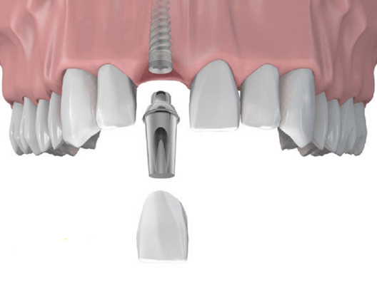 Trồng răng Implant